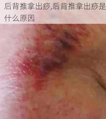 后背推拿出痧,后背推拿出痧是什么原因